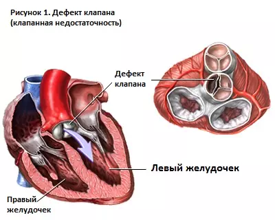Стеноз аортального клапана, недостаточность аортального клапана
